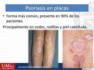Psoriasis en placas
• Forma más común, presente en 90% de los
pacientes.
Principalmente en codos, rodillas y piel cabelluda.
SALVADOR BERMUDEZ GARCIA
 
