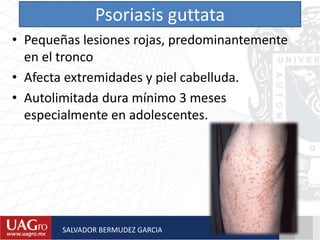 Psoriasis guttata
• Pequeñas lesiones rojas, predominantemente
en el tronco
• Afecta extremidades y piel cabelluda.
• Autolimitada dura mínimo 3 meses
especialmente en adolescentes.
SALVADOR BERMUDEZ GARCIA
 