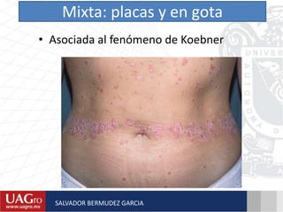Mixta: placas y en gota
• Asociada al fenómeno de Koebner
SALVADOR BERMUDEZ GARCIA
 