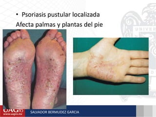 • Psoriasis pustular localizada
Afecta palmas y plantas del pie
SALVADOR BERMUDEZ GARCIA
 