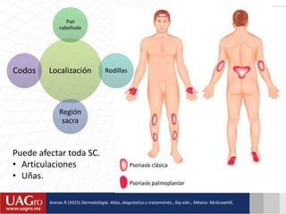 Puede afectar toda SC.
• Articulaciones
• Uñas.
Localización
Piel
cabelluda
Rodillas
Región
sacra
Codos
Arenas R (2015) Dermatología. Atlas, diagnóstico y tratamiento., 6ta edn., México: McGrawHill.
 