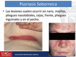 Psoriasis Seborreica
• Las lesiones suelen ocurrir en nariz, mejillas,
pliegues nasolabiales, cejas, frente, pliegues
inguinales y en el pecho.
SALVADOR BERMUDEZ GARCIA
 