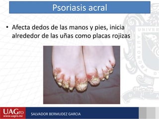 Psoriasis acral
• Afecta dedos de las manos y pies, inicia
alrededor de las uñas como placas rojizas
SALVADOR BERMUDEZ GARCIA
 