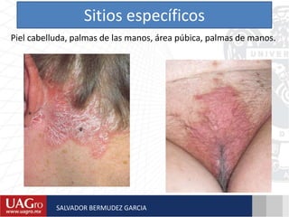 Sitios específicos
Piel cabelluda, palmas de las manos, área púbica, palmas de manos.
SALVADOR BERMUDEZ GARCIA
 