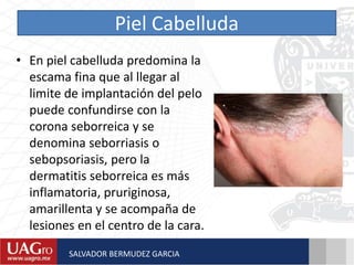 Piel Cabelluda
• En piel cabelluda predomina la
escama fina que al llegar al
limite de implantación del pelo
puede confundirse con la
corona seborreica y se
denomina seborriasis o
sebopsoriasis, pero la
dermatitis seborreica es más
inflamatoria, pruriginosa,
amarillenta y se acompaña de
lesiones en el centro de la cara.
SALVADOR BERMUDEZ GARCIA
 