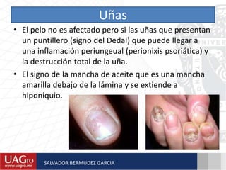 Uñas
• El pelo no es afectado pero si las uñas que presentan
un puntillero (signo del Dedal) que puede llegar a
una inflamación periungeual (perionixis psoriática) y
la destrucción total de la uña.
• El signo de la mancha de aceite que es una mancha
amarilla debajo de la lámina y se extiende a
hiponiquio.
SALVADOR BERMUDEZ GARCIA
 
