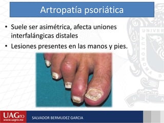 Artropatía psoriática
• Suele ser asimétrica, afecta uniones
interfalángicas distales
• Lesiones presentes en las manos y pies.
SALVADOR BERMUDEZ GARCIA
 
