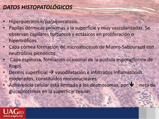 DATOS HISTOPATOLÓGICOS
• Hiperqueratosis/paraqueratosis.
• Papilas dérmicas próximas a la superficie y muy vascularizadas. Se
observan capilares tortuosos y ectásicos en proliferación o
hipertróficos.
• Capa córnea formación de microabscesos de Munro-Sabouraud con
neutrófilos picnóticos
• Capa espinosa, formación ocasional de la pústula espongiforme de
Kogoj.
• Dermis superficial  vasodilatación e infiltrados inflamatorios
moderados, constituidos mononucleares.
• Adherencia celular está limitada a los desmosomas, por  neta de
glucoproteínas en la superficie celular.
 