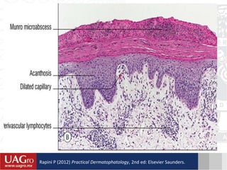 Rapini P (2012) Practical Dermatophatology, 2nd ed: Elsevier Saunders.
 