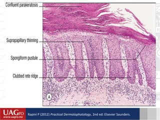 Rapini P (2012) Practical Dermatophatology, 2nd ed: Elsevier Saunders.
 