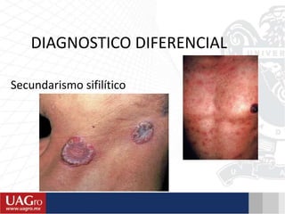DIAGNOSTICO DIFERENCIAL
Secundarismo sifilítico
 