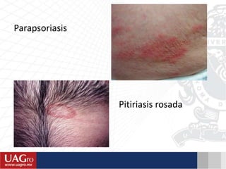 Parapsoriasis
Pitiriasis rosada
 