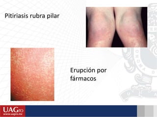 Pitiriasis rubra pilar
Erupción por
fármacos
 