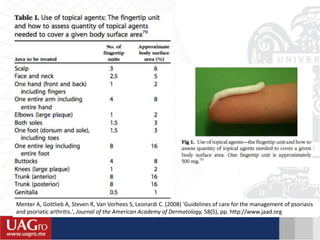 Menter A, Gottlieb A, Steven R, Van Vorhees S, Leonardi C. (2008) 'Guidelines of care for the management of psoriasis
and psoriatic arthritis.', Journal of the American Academy of Dermatology, 58(5), pp. http://www.jaad.org
 