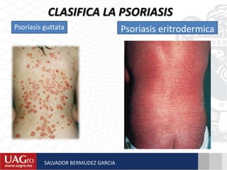 CLASIFICA LA PSORIASIS
Psoriasis guttata Psoriasis eritrodermica
SALVADOR BERMUDEZ GARCIA
 