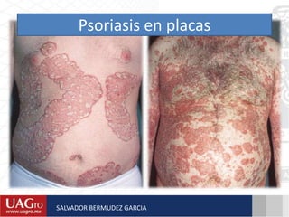 Psoriasis en placas
SALVADOR BERMUDEZ GARCIA
 