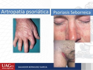 Artropatía psoriática Psoriasis Seborreica
SALVADOR BERMUDEZ GARCIA
 