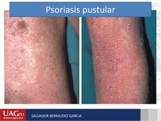 Psoriasis pustular
SALVADOR BERMUDEZ GARCIA
 