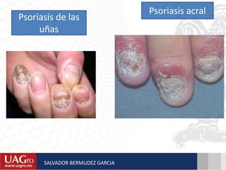 Psoriasis acral
Psoriasis de las
uñas
SALVADOR BERMUDEZ GARCIA
 