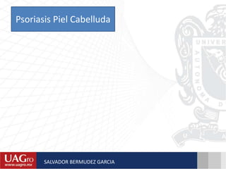 Psoriasis Piel Cabelluda
SALVADOR BERMUDEZ GARCIA
 
