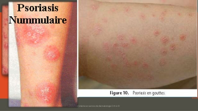 Que traiter le psoriasis inverse