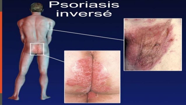 Polifepan pour le psoriasis