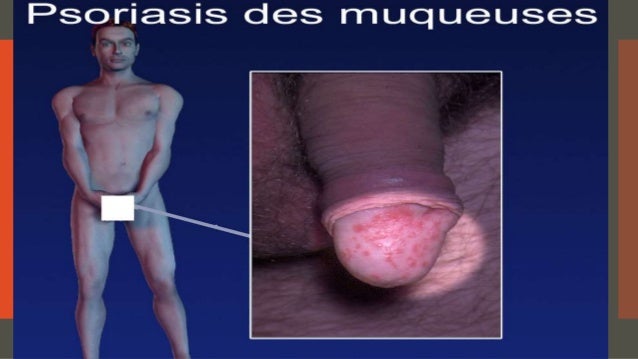 Des eczémas et la démangeaison