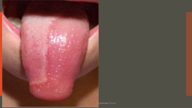 Que lon ne peut pas manger au psoriasis sur la personne