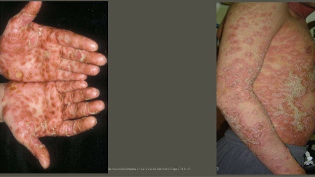 Si on peut faire les enveloppements au psoriasis