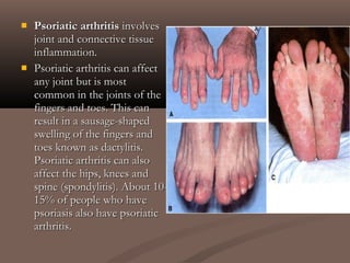  Psoriatic arthritisPsoriatic arthritis involvesinvolves
joint and connective tissuejoint and connective tissue
inflammation.inflammation.
 Psoriatic arthritis can affectPsoriatic arthritis can affect
any joint but is mostany joint but is most
common in the joints of thecommon in the joints of the
fingers and toes. This canfingers and toes. This can
result in a sausage-shapedresult in a sausage-shaped
swelling of the fingers andswelling of the fingers and
toes known as dactylitis.toes known as dactylitis.
Psoriatic arthritis can alsoPsoriatic arthritis can also
affect the hips, knees andaffect the hips, knees and
spine (spondylitis). About 10-spine (spondylitis). About 10-
15% of people who have15% of people who have
psoriasis also have psoriaticpsoriasis also have psoriatic
arthritis.arthritis.
 