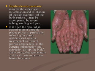  Erythrodermic psoriasisErythrodermic psoriasis
involves the widespreadinvolves the widespread
inflammation and exfoliationinflammation and exfoliation
of the skin over most of theof the skin over most of the
body surface. It may bebody surface. It may be
accompanied by severeaccompanied by severe
itching, swelling and pain.itching, swelling and pain.
 It is often the result of anIt is often the result of an
exacerbation of unstableexacerbation of unstable
plaque psoriasis, particularlyplaque psoriasis, particularly
following the abruptfollowing the abrupt
withdrawal of systemicwithdrawal of systemic
treatment. This form oftreatment. This form of
psoriasis can be fatal, as thepsoriasis can be fatal, as the
extreme inflammation andextreme inflammation and
exfoliation disrupt the body'sexfoliation disrupt the body's
ability to regulate temperatureability to regulate temperature
and for the skin to performand for the skin to perform
barrier functions.barrier functions.
 