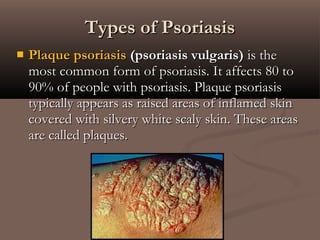  Plaque psoriasisPlaque psoriasis (psoriasis vulgaris)(psoriasis vulgaris) is theis the
most common form of psoriasis. It affects 80 tomost common form of psoriasis. It affects 80 to
90% of people with psoriasis. Plaque psoriasis90% of people with psoriasis. Plaque psoriasis
typically appears as raised areas of inflamed skintypically appears as raised areas of inflamed skin
covered with silvery white scaly skin. These areascovered with silvery white scaly skin. These areas
are called plaques.are called plaques.
Types of PsoriasisTypes of Psoriasis
 