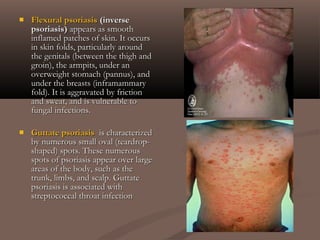  Flexural psoriasisFlexural psoriasis (inverse(inverse
psoriasis)psoriasis) appears as smoothappears as smooth
inflamed patches of skin. It occursinflamed patches of skin. It occurs
in skin folds, particularly aroundin skin folds, particularly around
the genitals (between the thigh andthe genitals (between the thigh and
groin), the armpits, under angroin), the armpits, under an
overweight stomach (pannus), andoverweight stomach (pannus), and
under the breasts (inframammaryunder the breasts (inframammary
fold). It is aggravated by frictionfold). It is aggravated by friction
and sweat, and is vulnerable toand sweat, and is vulnerable to
fungal infections.fungal infections.
 Guttate psoriasisGuttate psoriasis is characterizedis characterized
by numerous small oval (teardrop-by numerous small oval (teardrop-
shaped) spots. These numerousshaped) spots. These numerous
spots of psoriasis appear over largespots of psoriasis appear over large
areas of the body, such as theareas of the body, such as the
trunk, limbs, and scalp. Guttatetrunk, limbs, and scalp. Guttate
psoriasis is associated withpsoriasis is associated with
streptococcal throat infectionstreptococcal throat infection
 