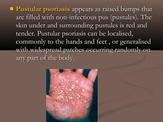  Pustular psoriasisPustular psoriasis appears as raised bumps thatappears as raised bumps that
are filled with non-infectious pus (pustules). Theare filled with non-infectious pus (pustules). The
skin under and surrounding pustules is red andskin under and surrounding pustules is red and
tender. Pustular psoriasis can be localised,tender. Pustular psoriasis can be localised,
commonly to the hands and feet , or generalisedcommonly to the hands and feet , or generalised
with widespread patches occurring randomly onwith widespread patches occurring randomly on
any part of the body.any part of the body.
 