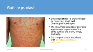 Guttate psoriasis
• Guttate psoriasis is characterized
by numerous small oval
(teardrop-shaped) spots.
• These numerous spots of psoriasis
appear over large areas of the
body, such as the trunk, limbs,
and scalp.
• Guttate psoriasis is associated
with streptococcal throat
infection
16/05/2020 Psoriasis (Dr Akshay Shetty) 10
 