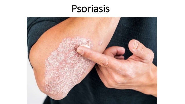 Psoriasis
 