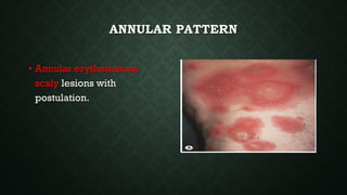 ANNULAR PATTERN
• Annular erythematous
scaly lesions with
postulation.
 