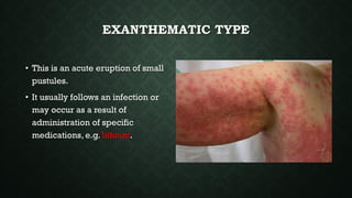 EXANTHEMATIC TYPE
• This is an acute eruption of small
pustules.
• It usually follows an infection or
may occur as a result of
administration of specific
medications, e.g. lithium.
 