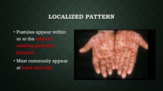 LOCALIZED PATTERN
• Pustules appear within
or at the edge of
existing psoriatic
plaques
• Most commonly appear
at hand and sole
 