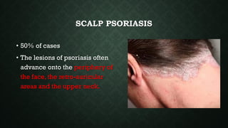 SCALP PSORIASIS
• 50% of cases
• The lesions of psoriasis often
advance onto the periphery of
the face, the retro-auricular
areas and the upper neck.
 