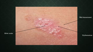 Well demarcated
Erythematous
Silver scale
 