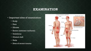 EXAMINATION
• Important sites of examination:
• Scalp
• Ears
• Elbows
• Knees (extensor surfaces)
• Umbilicus
• Gluteal cleft
• Nails
• Sites of recent trauma
 