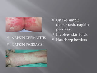 Napkin Rash PSORIASIS. Peppy.pptxddddddddddssddddddds | PPTX