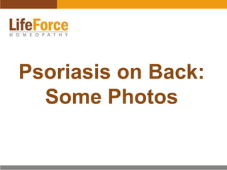 Psoriasis on Back:
Some Photos
 