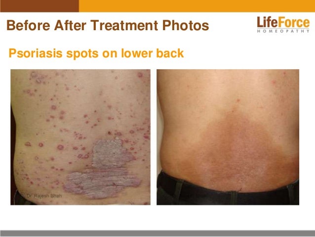 Psoriasis on Back Photos: Before After Treatment Pictures of Patients…
