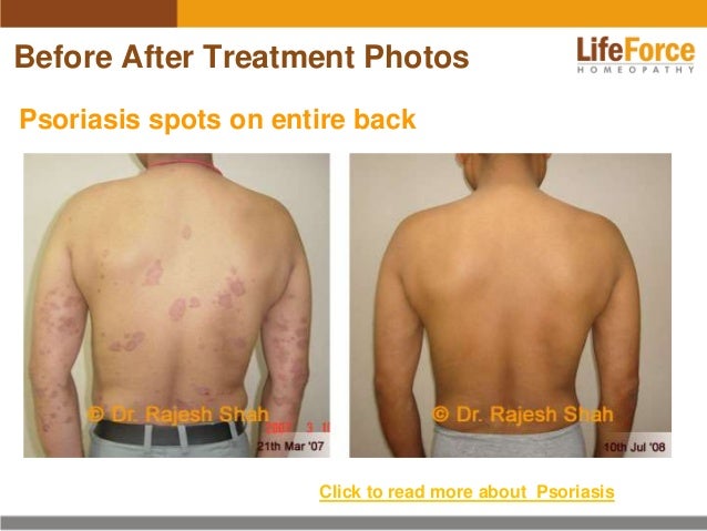 Psoriasis On Back Photos Before After Treatment Pictures Of Patients
