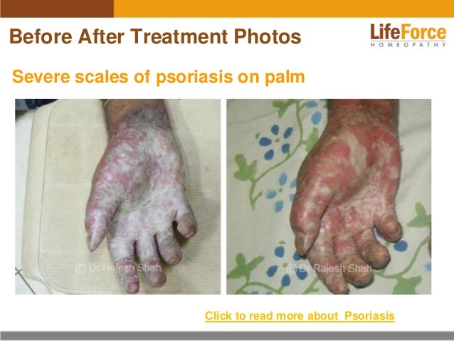Psoriasis - Symptoms, Triggers, and Causes of Psoriasis on ...