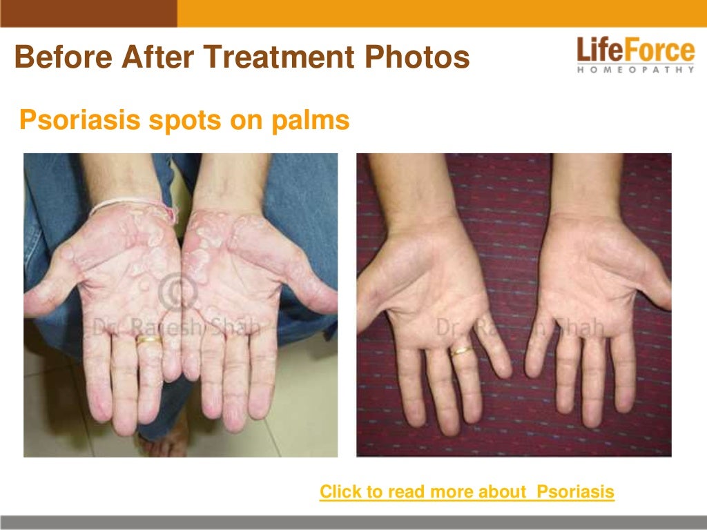 Psoriasis on Hands Photos Before and After Treatment Pictures of Pat…