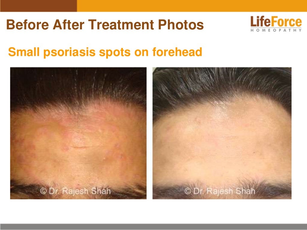 Psoriasis on Scalp & Head Photos Before After Treatment Pictures