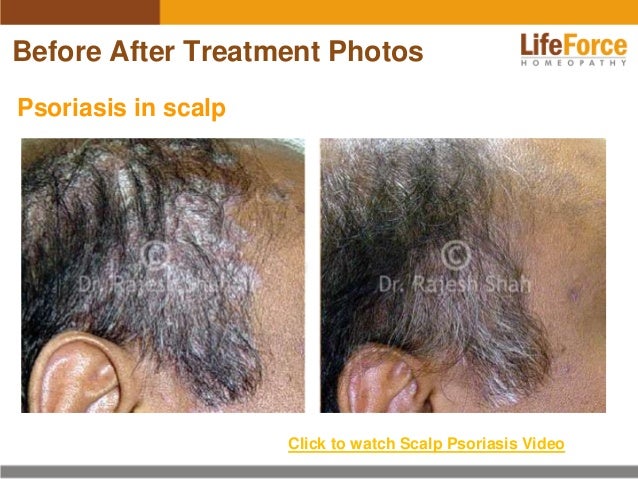 Psoriasis On Scalp Head Photos Before After Treatment Pictures